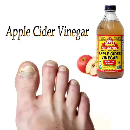 Apple Cider Vinegar For Toenail Fungus