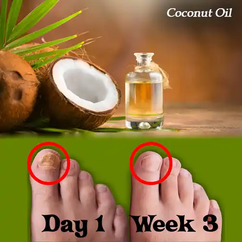 Coconut Oil For Toenail Fungus