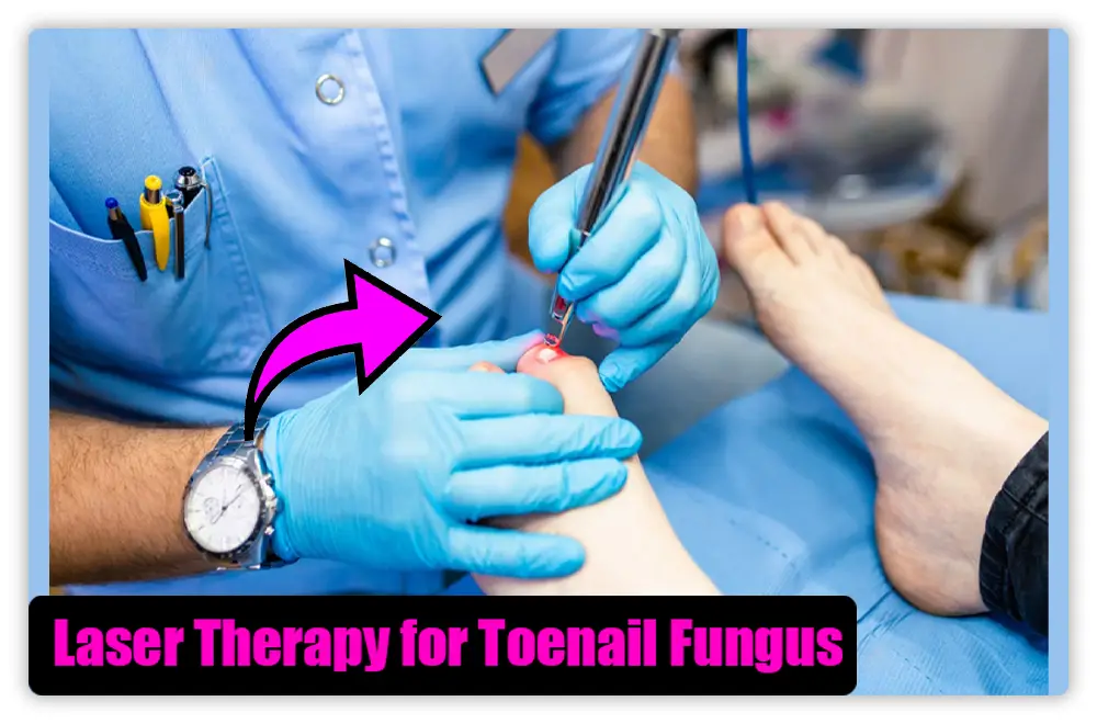 Laser Therapy for Toenail Fungus