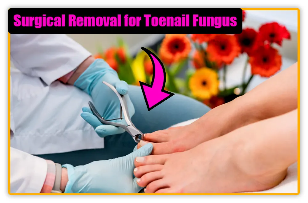 Surgical Removal for Toenail Fungus